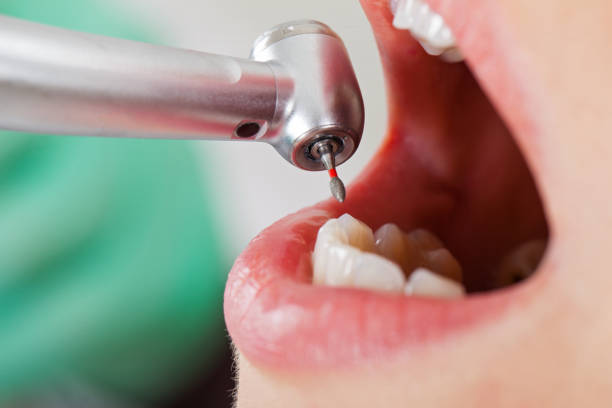 Best Emergency Wisdom Teeth Removal in Leupp, AZ